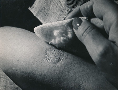 Brodsky remède racines bardanes dermatoses photo photographie