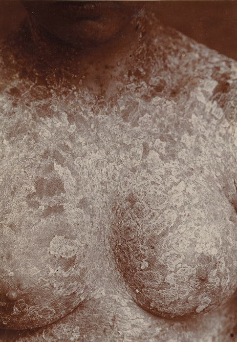 photographie Budin 1908 Ste Agnès maladie